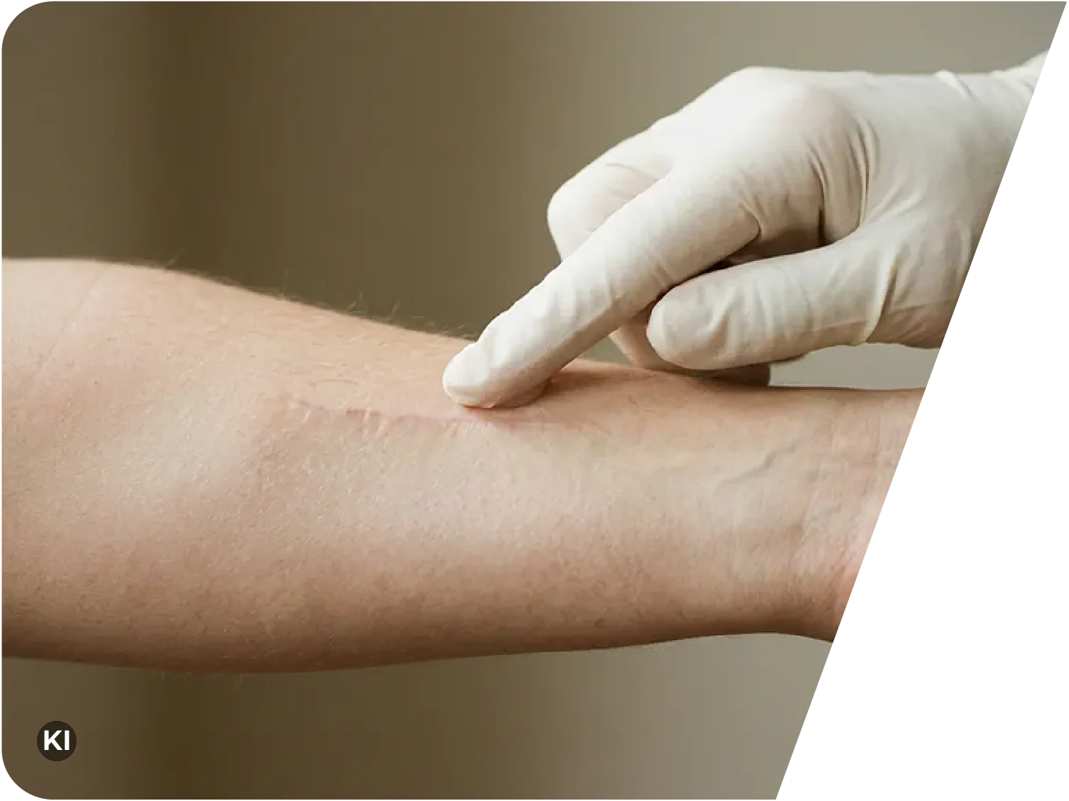 Hand mit weißem Einmalhandschuh berührt eine Narbe am Unterarm einer Person