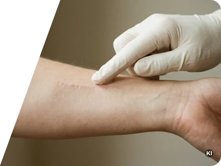 Hand mit medizinischem Handschuh berührt eine Narbe am Unterarm einer Person