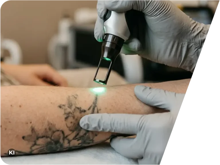 Hand mit medizinischem Handschuh hält ein Lasergerät mit grünem Licht über einen Unterarm mit schwarzem Blumen-Tattoo zur Entfernung