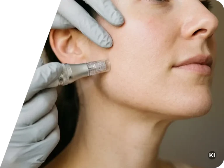 Nahaufnahme einer Person, die eine Microneedling-Behandlung im Gesicht erhält, durchgeführt von einer Person mit Handschuhen